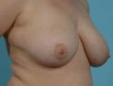 Patient # 62433 Before Photo # 3
